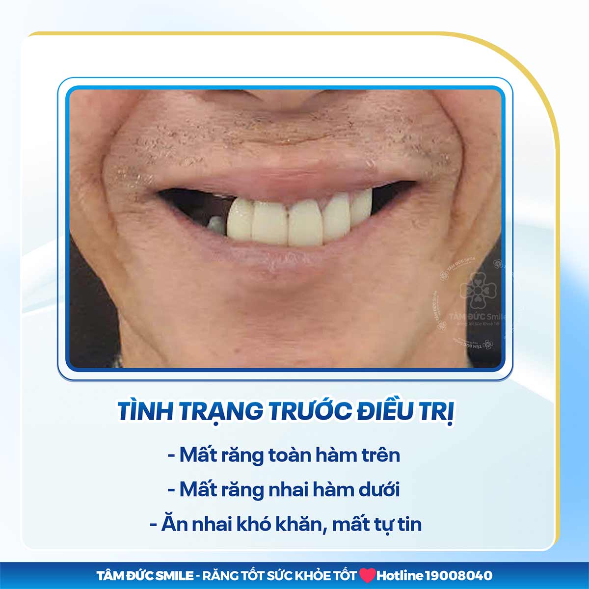 5 ẢNH HƯỞNG NGHIÊM TRỌNG KHI BỊ MẤT RĂNG VĨNH VIỄN VÀ GIẢI PHÁP HỮU HIỆU