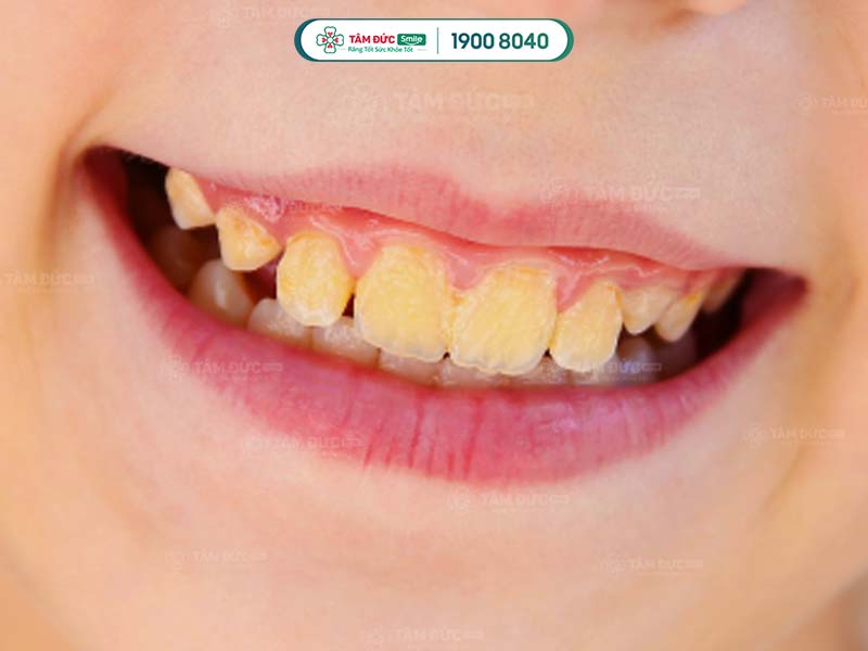 Mảng bám còn sót lại làm trẻ bị hôi miệng, nên dùng bàn chải điện cho trẻ em làm sạch răng miệng hiệu quả