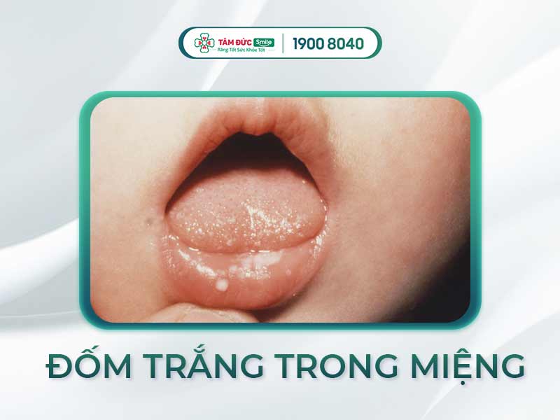 BẬT MÍ DẤU HIỆU NHẬN BIẾT NẤM MIỆNG Ở TRẺ SƠ SINH VÀ CÁCH ĐIỀU TRỊ DỨT ĐIỂM