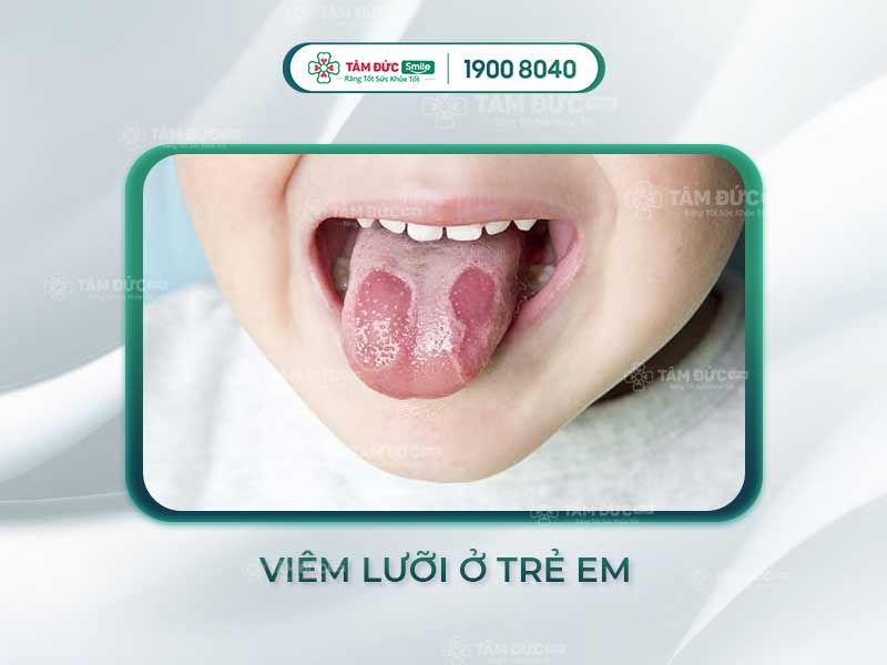 BỆNH VIÊM LƯỠI Ở TRẺ EM CÓ NGUY HIỂM KHÔNG? CÁCH KHẮC PHỤC & ĐIỀU TRỊ