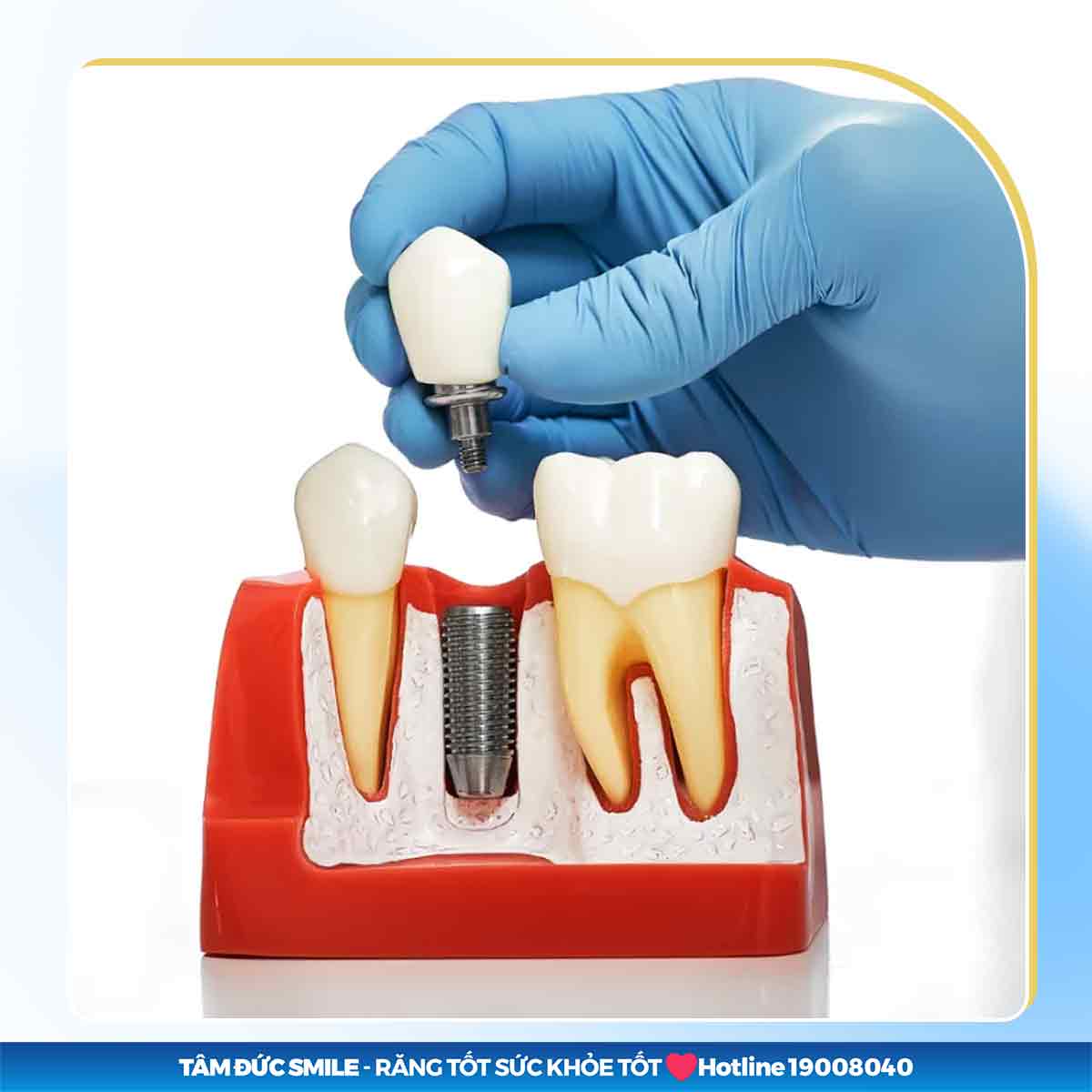 BỊ CAO HUYẾT ÁP CÓ TRỒNG IMPLANT ĐƯỢC KHÔNG?