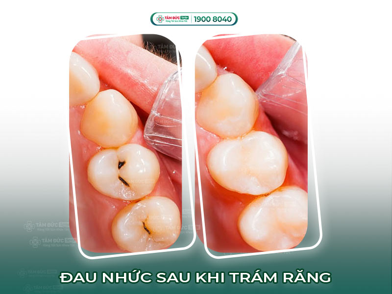 BỊ ĐAU NHỨC SAU KHI TRÁM RĂNG CÓ NGUY HIỂM KHÔNG?