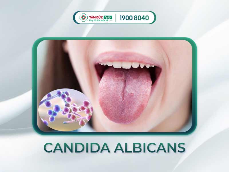 BỊ NHIỄM NẤM MIỆNG CANDIDA CÓ NGUY HIỂM KHÔNG?