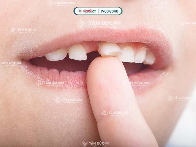 răng lung lay ở trẻ nhỏ