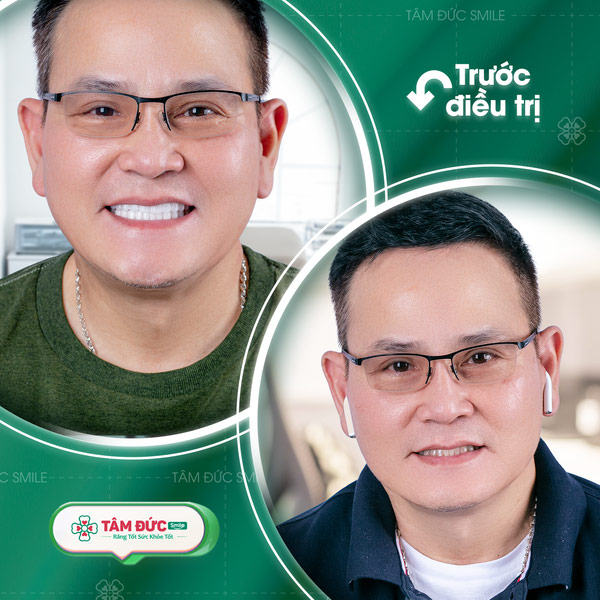 hình ảnh anh Hoà sau khi bọc răng sứ tại Tâm Đức Smile