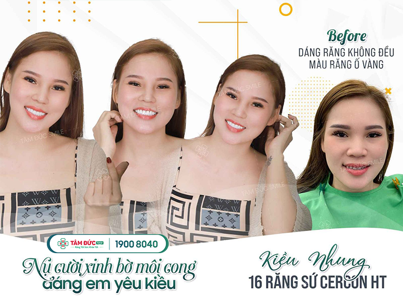 BỌC RĂNG SỨ Ở ĐÂU TỐT NHẤT?