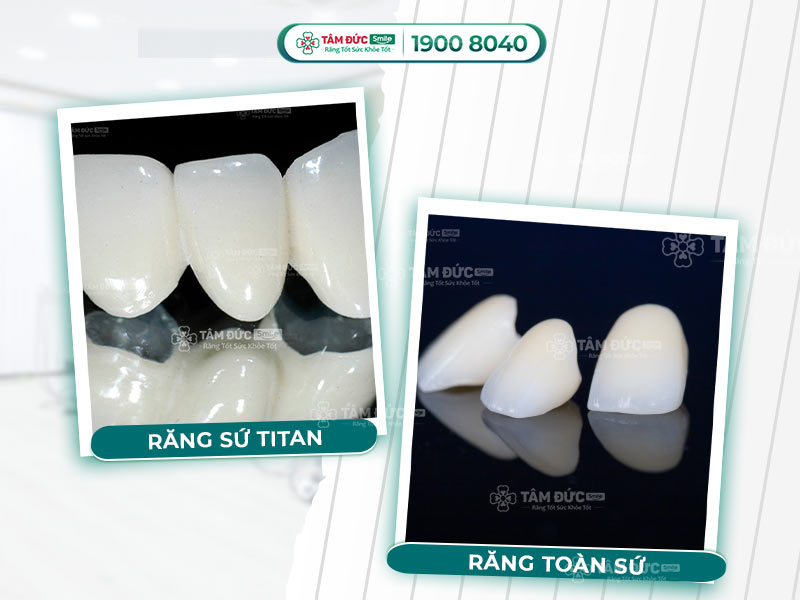 BỌC RĂNG SỨ TITAN CÓ NÊN HAY KHÔNG?