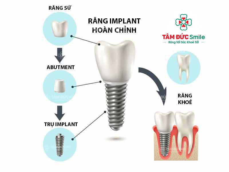 cấu tạo các thành phần của răng implant
