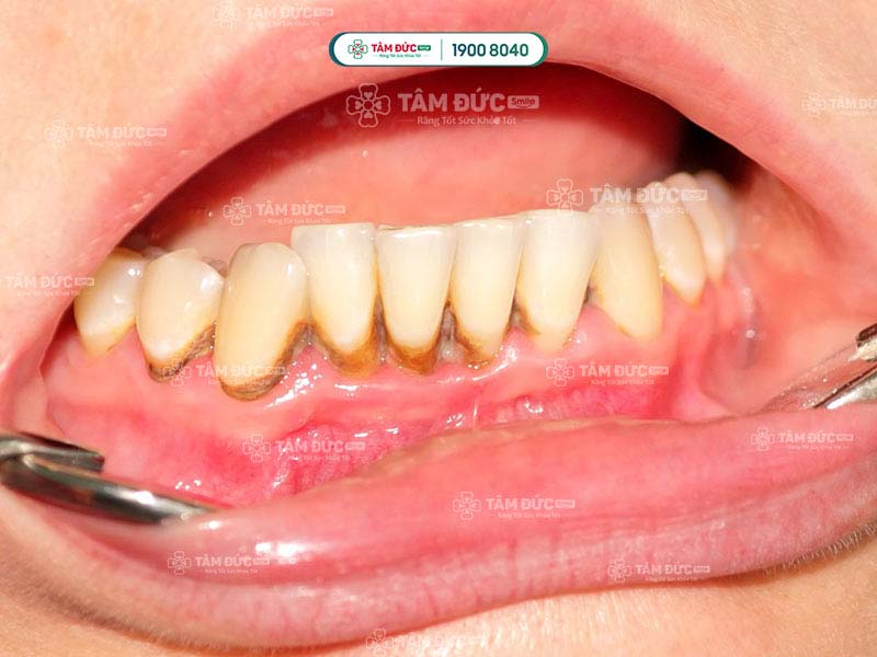 Cao răng độ 3 có màu vàng đậm, nâu, nâu nhạt gây mất thẩm mỹ