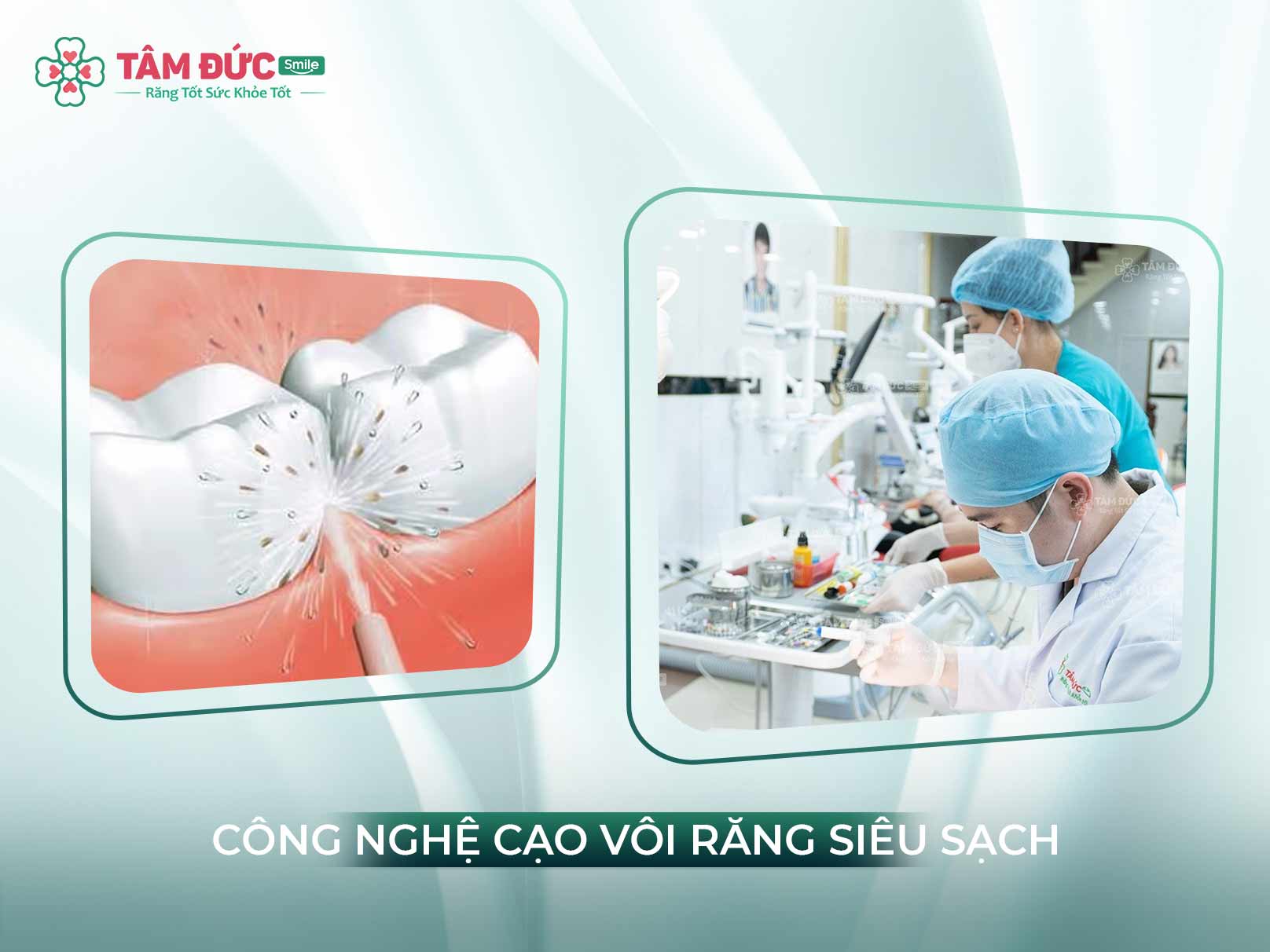 CẠO VÔI RĂNG SIÊU SẠCH BẰNG CÔNG NGHỆ SÓNG SIÊU ÂM