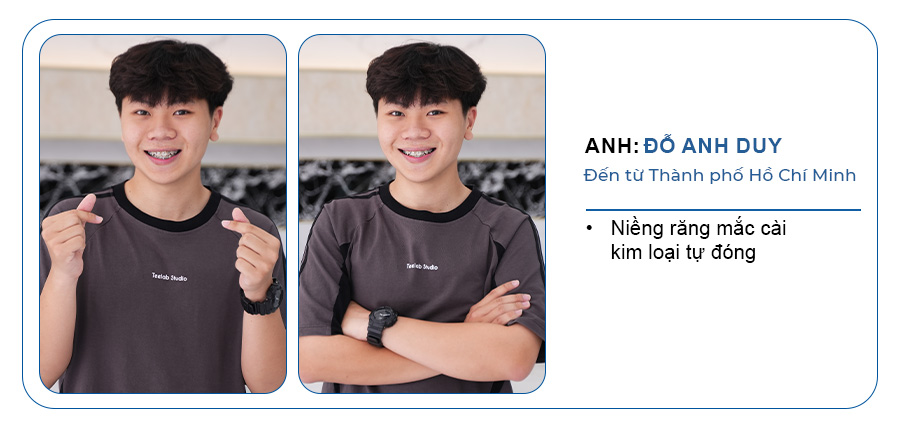 khách hàng niềng răng mắc cài kim loại