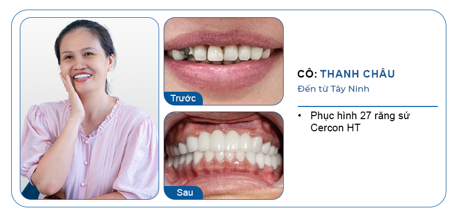 khách hàng làm răng sứ