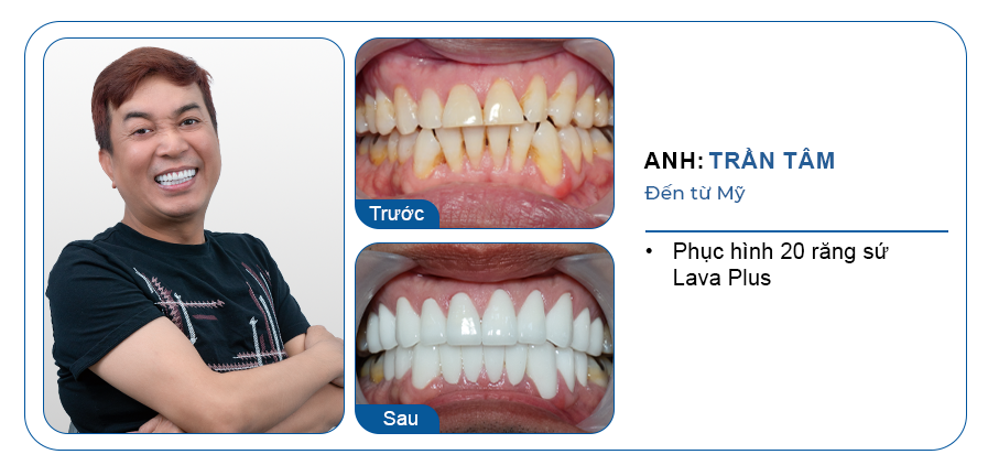 khách hàng việt kiều trồng răng implant