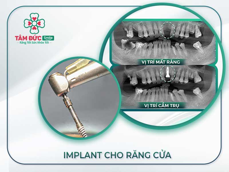 IMPLANT RĂNG CỬA CÓ ĐẮT KHÔNG? TÌM NƠI TRỒNG RĂNG CỬA UY TÍN GIÁ TỐT