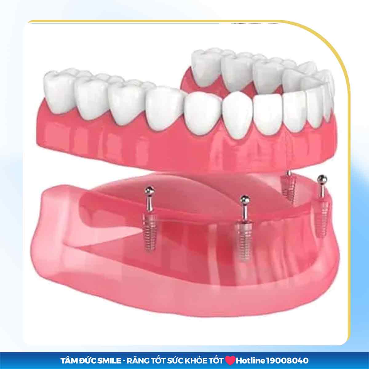 CẤY GHÉP MINI IMPLANT GIÁ BAO NHIÊU MỚI NHẤT HIỆN NAY