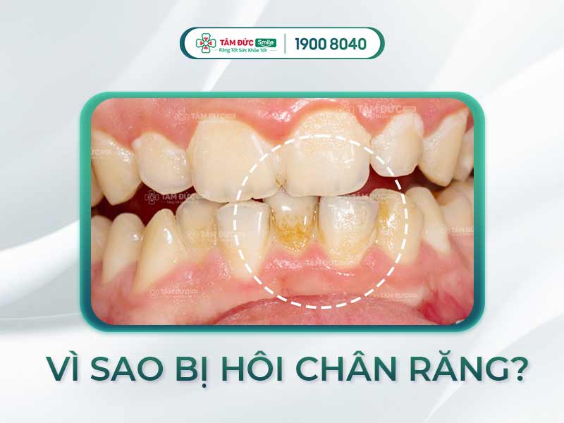CHÂN RĂNG CÓ MÙI HÔI NGUYÊN NHÂN DO ĐÂU? LÀM SAO ĐỂ KHẮC PHỤC?