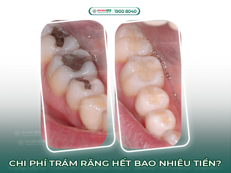 CHI PHÍ TRÁM RĂNG HẾT BAO NHIÊU TIỀN?