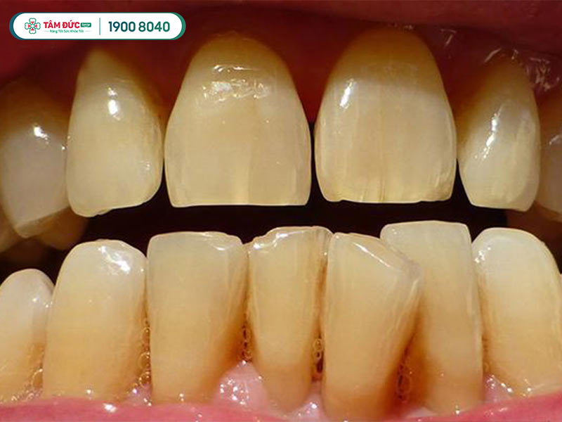 có nên tẩy trắng răng không