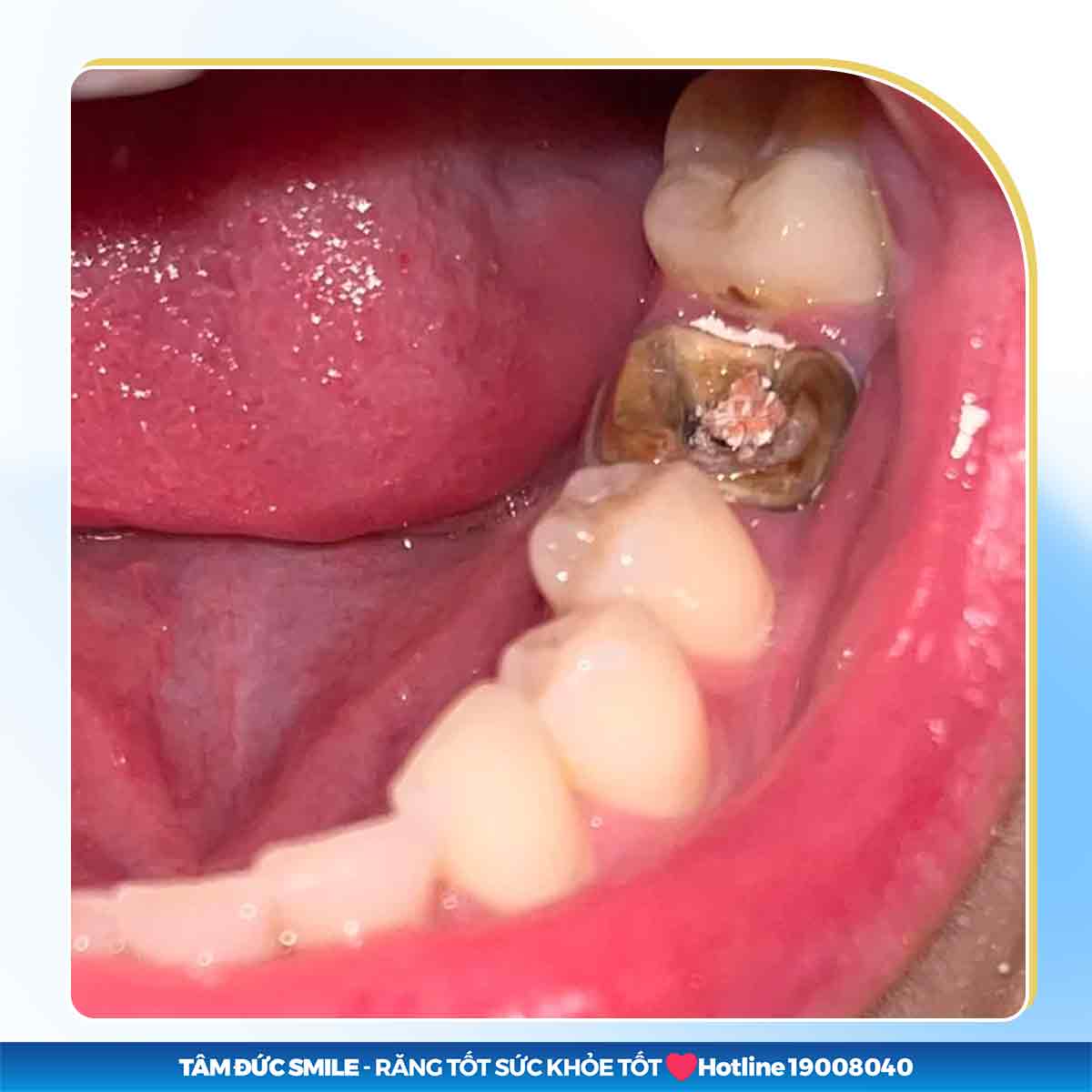 CÒN CHÂN RĂNG CÓ BỊ TIÊU XƯƠNG KHÔNG? CÓ BỌC RĂNG SỨ ĐƯỢC KHÔNG?