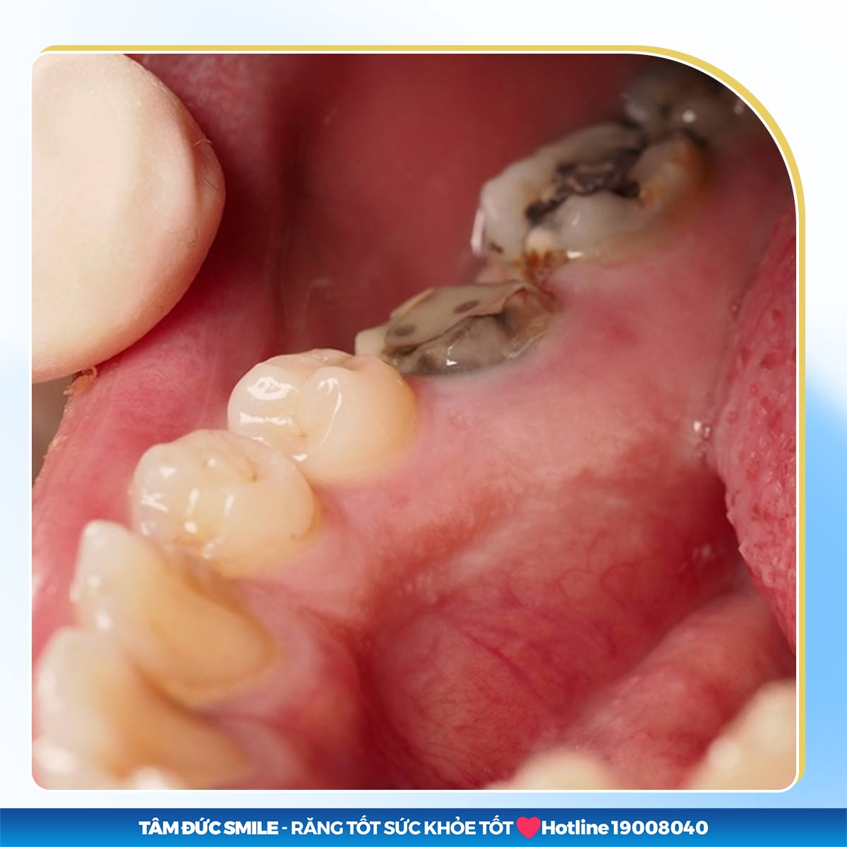 CÒN CHÂN RĂNG CÓ NÊN NHỔ KHÔNG? GIẢI PHÁP TỐT NGAY LÚC NÀY