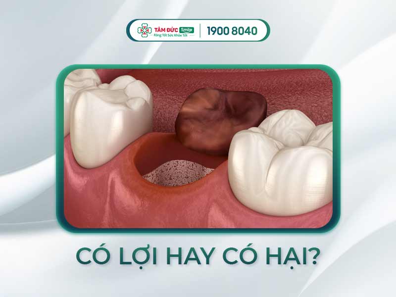 CỤC MÁU ĐÔNG Ổ RĂNG XUẤT HIỆN SAU KHI NHỔ RĂNG CÓ TỐT KHÔNG?