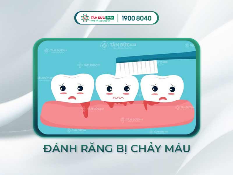 ĐÁNH RĂNG CHẢY MÁU CÓ NGUY HIỂM KHÔNG? NGUYÊN NHÂN BỊ CHẢY MÁU RĂNG