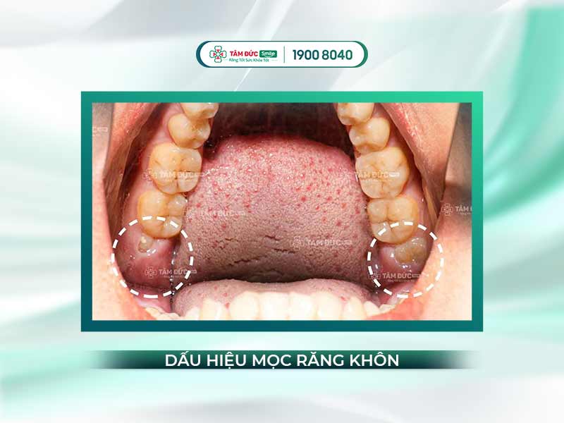 DẤU HIỆU MỌC RĂNG KHÔN Ở NGƯỜI LỚN VÀ CÁCH XỬ LÝ