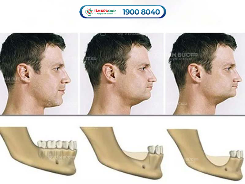 dấu hiệu tiêu xương răng khi nhìn qua cấu trúc khuôn mặt