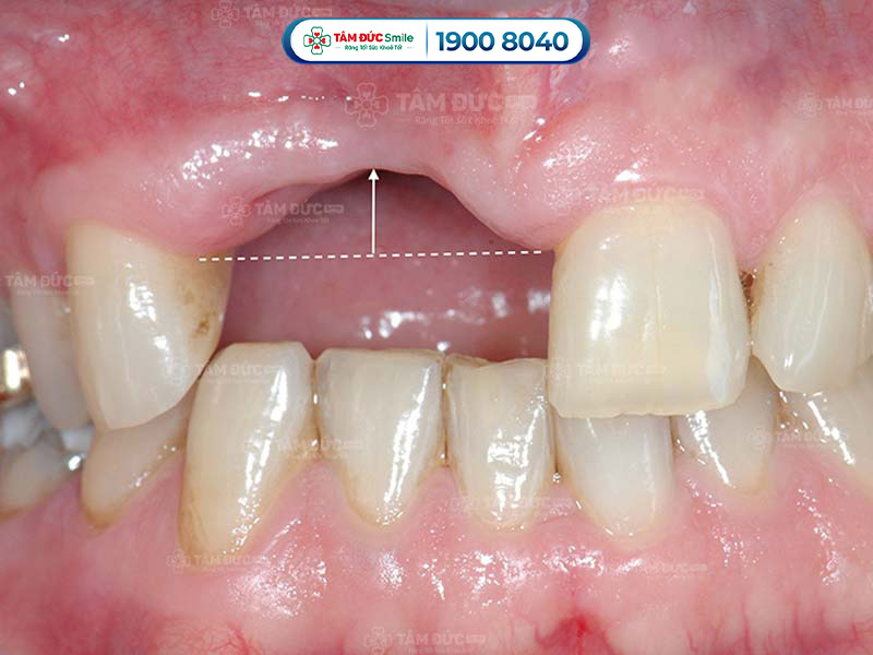 dấu hiệu tiêu xương răng khi nhìn bằng mắt thường