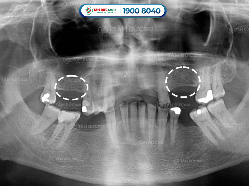 dấu hiệu tiêu xương răng qua từng giai đoạn