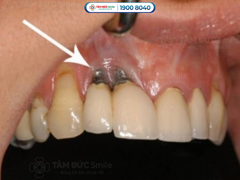 Dấu hiệu trụ Implant bị đào thải