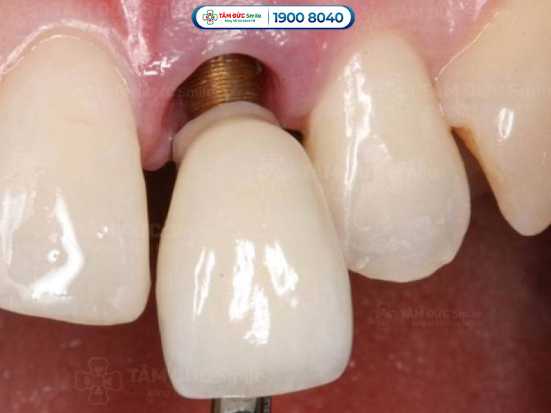 Dấu hiệu trụ Implant bị đào thải