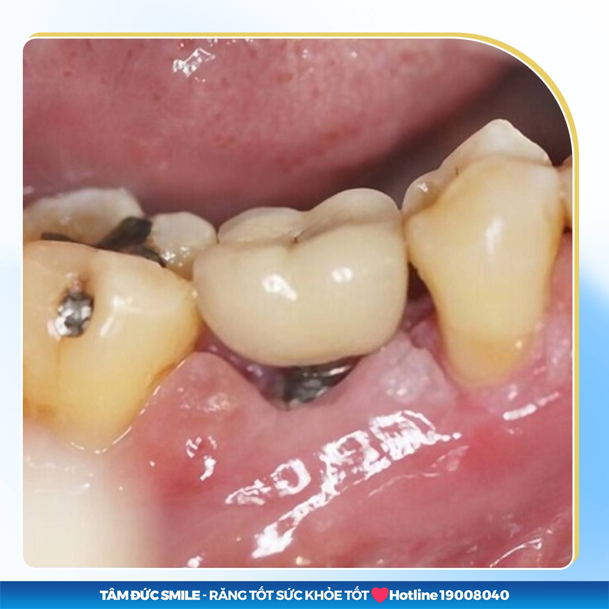 3+ DẤU HIỆU TRỤ IMPLANT BỊ ĐÀO THẢI VÀ CÁCH XỬ LÝ AN TOÀN