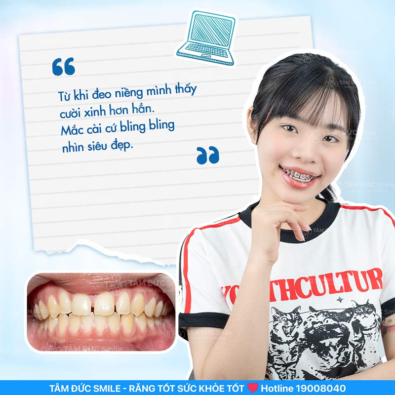 ưu đãi dịch vụ niềng răng thẩm mỹ