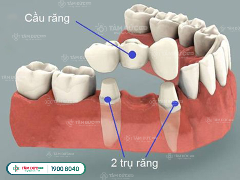 Giá làm cầu răng sứ bao nhiêu tiền