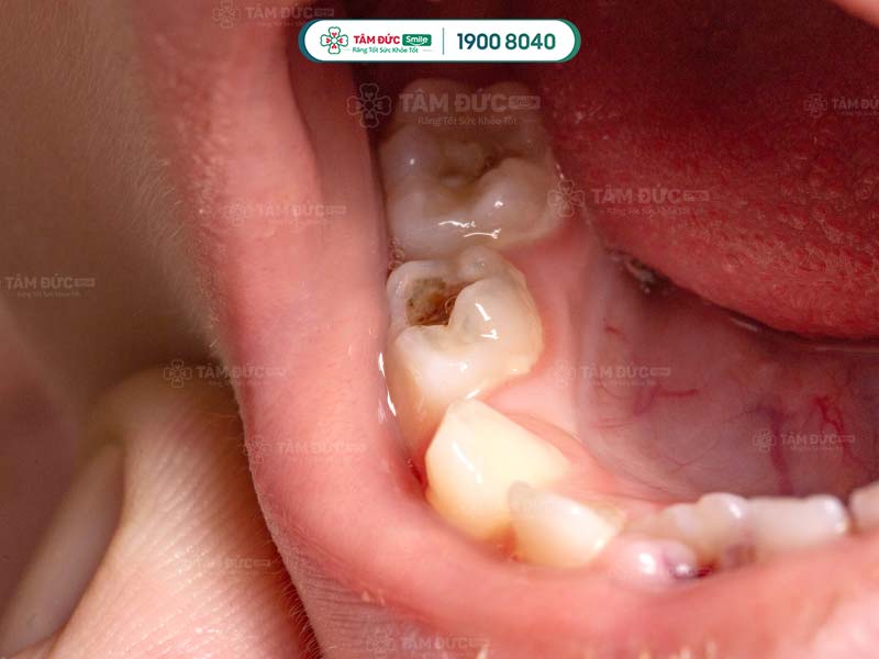 Sâu răng gây đau nhức dai dẳng