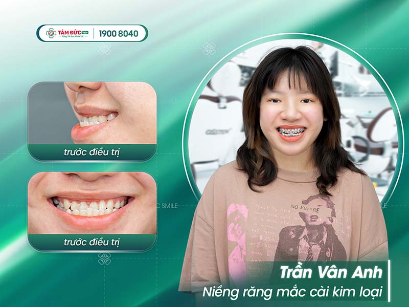 khách hàng niềng răng móm tại nha khoa Tâm Đức Smile