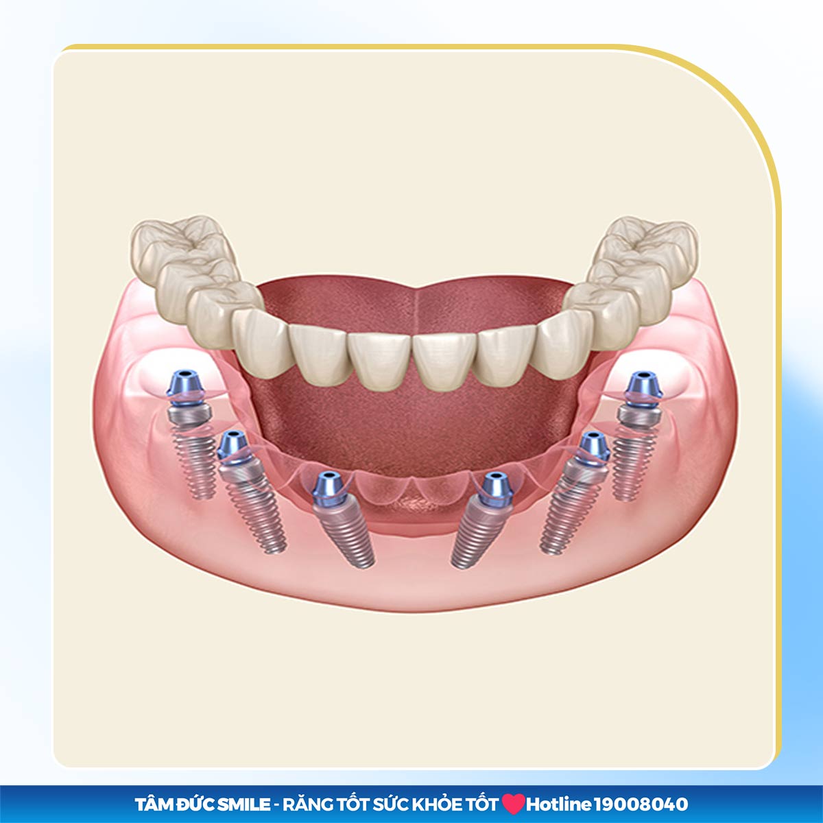 IMPLANT ALL ON 6 LÀ GÌ? KHI NÀO NÊN TRỒNG RĂNG BẰNG IMPLANT ALL ON 6?