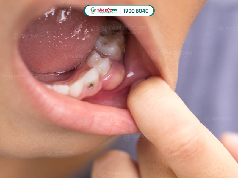 làm gì khi bị vỡ áp xe răng