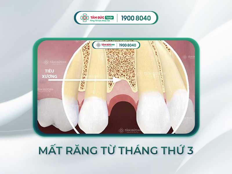MẤT RĂNG BAO LÂU THÌ BỊ TIÊU XƯƠNG HÀM? CÁC DẠNG TIÊU XƯƠNG HÀM VÀ CÁCH CHỮA