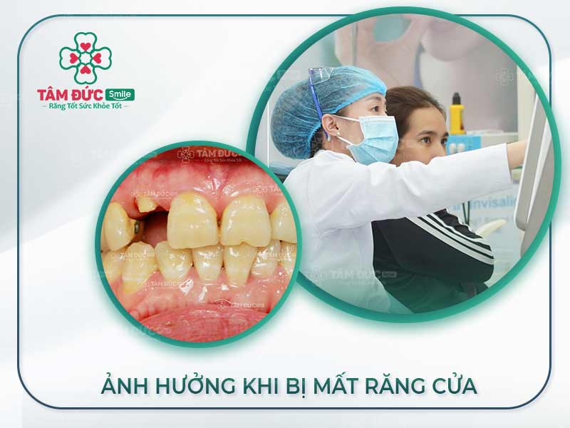 MẤT RĂNG CỬA VÀ NHỮNG HẬU QUẢ KHÔN LƯỜNG
