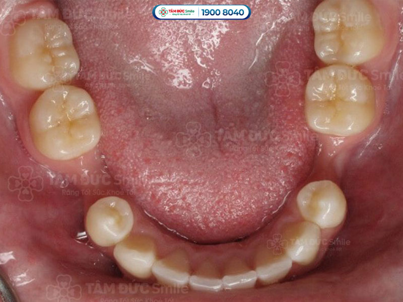 MẤT RĂNG LÂU NĂM CÓ TRỒNG RĂNG IMPLANT ĐƯỢC KHÔNG