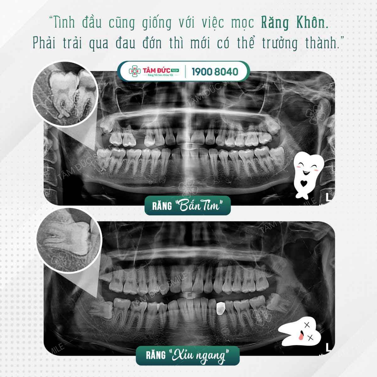 Mọc răng khôn có ý nghĩa gì