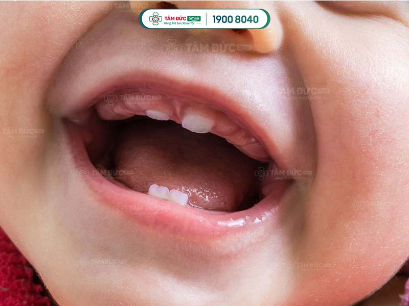 Sốt mọc răng ở trẻ tự khỏi sau 3 – 4 ngày