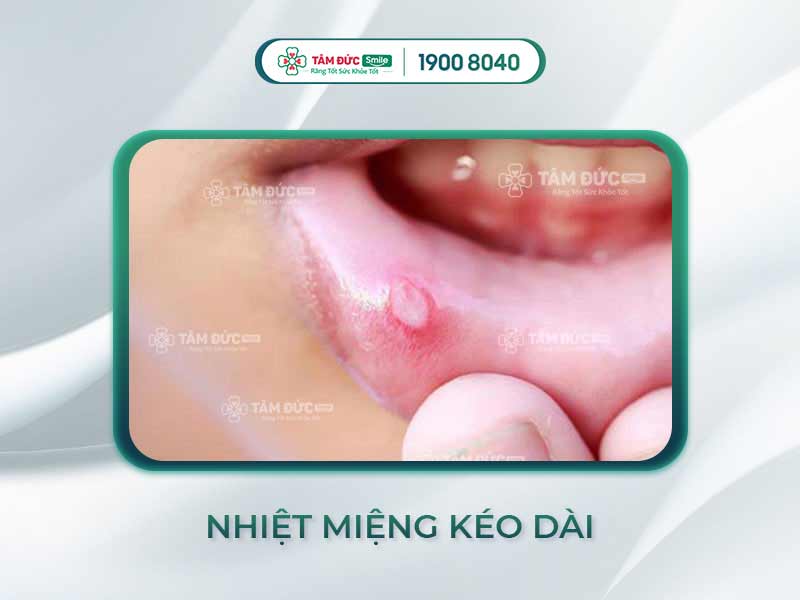 NGUYÊN NHÂN BỆNH NHIỆT MIỆNG KÉO DÀI -  PHƯƠNG PHÁP ĐIỀU TRỊ DỨT ĐIỂM