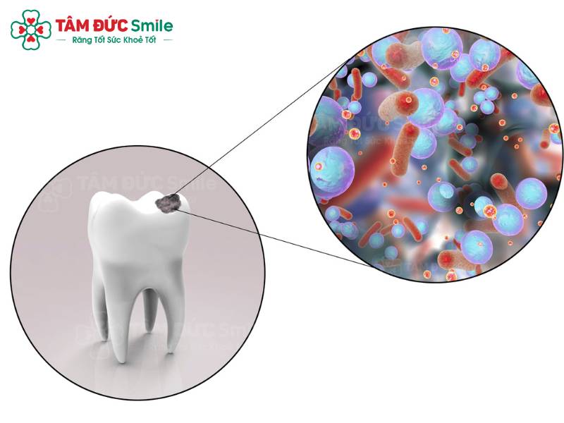 tại sao uống nước lạnh răng bị buốt
