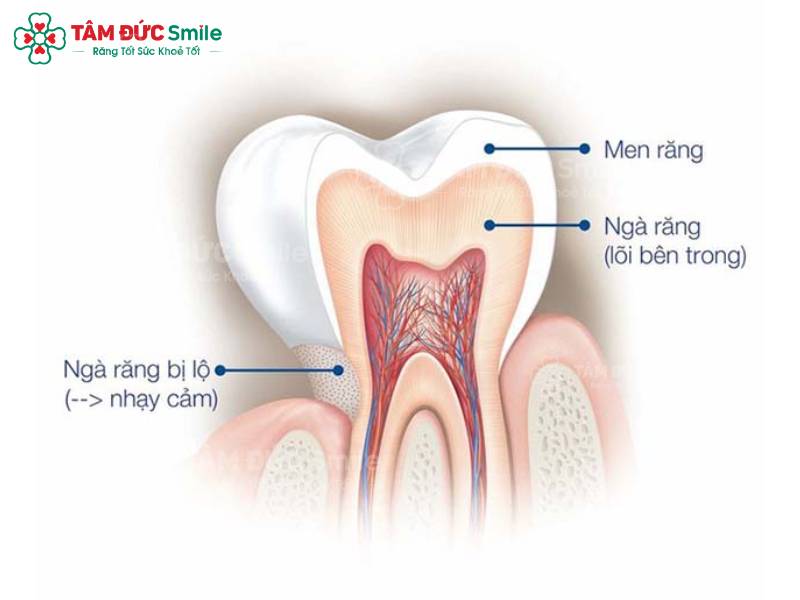 tại sao uống nước lạnh răng bị buốt