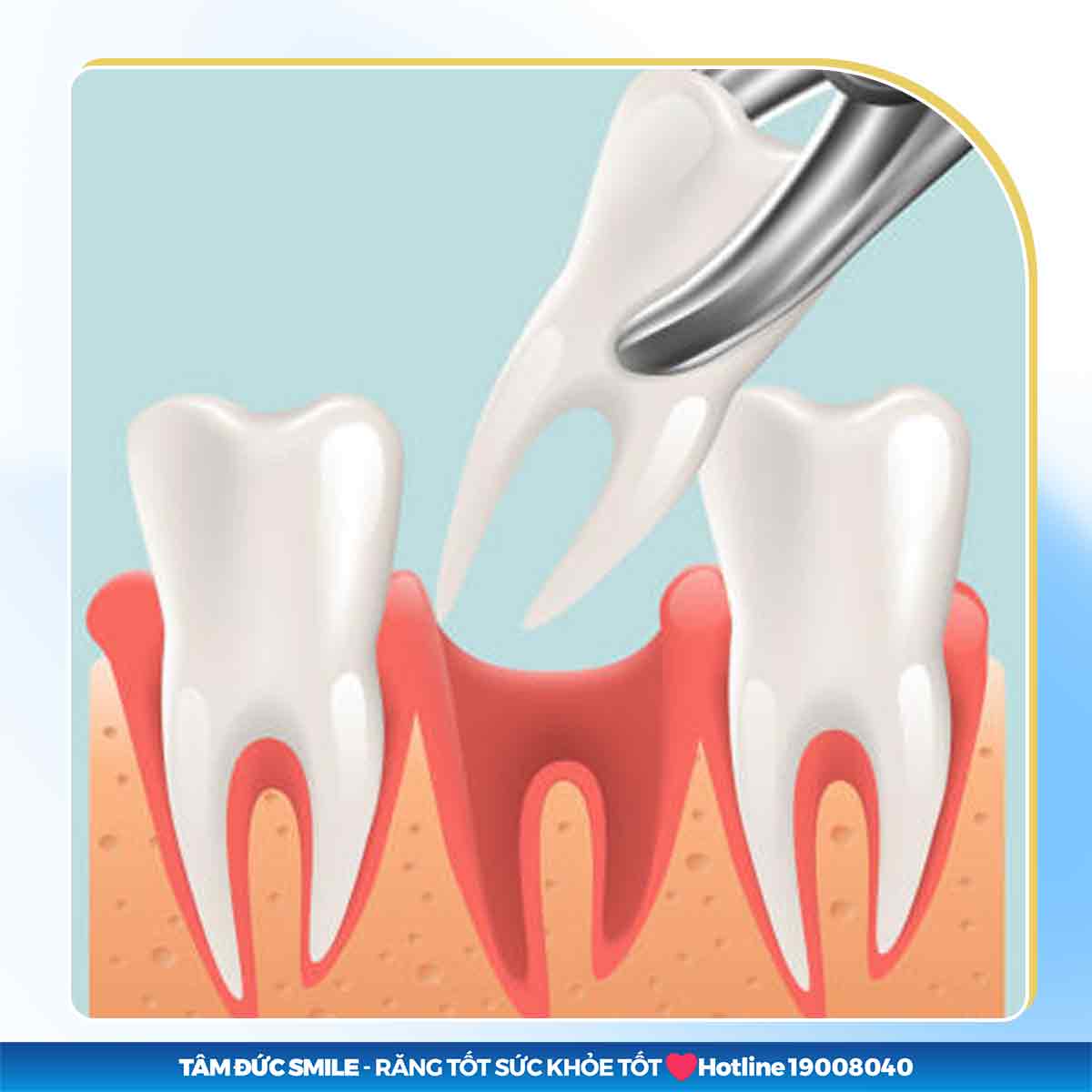 NHỔ RĂNG CẤM CÓ CẦN PHẢI TRỒNG LẠI KHÔNG?
