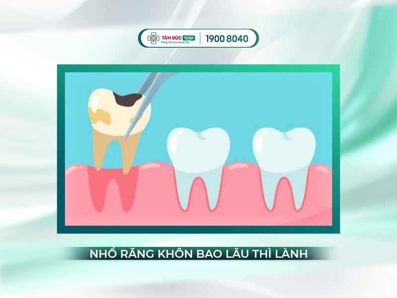 NHỔ RĂNG KHÔN BAO LÂU THÌ LÀNH VÀ NÊN KIÊNG GÌ?