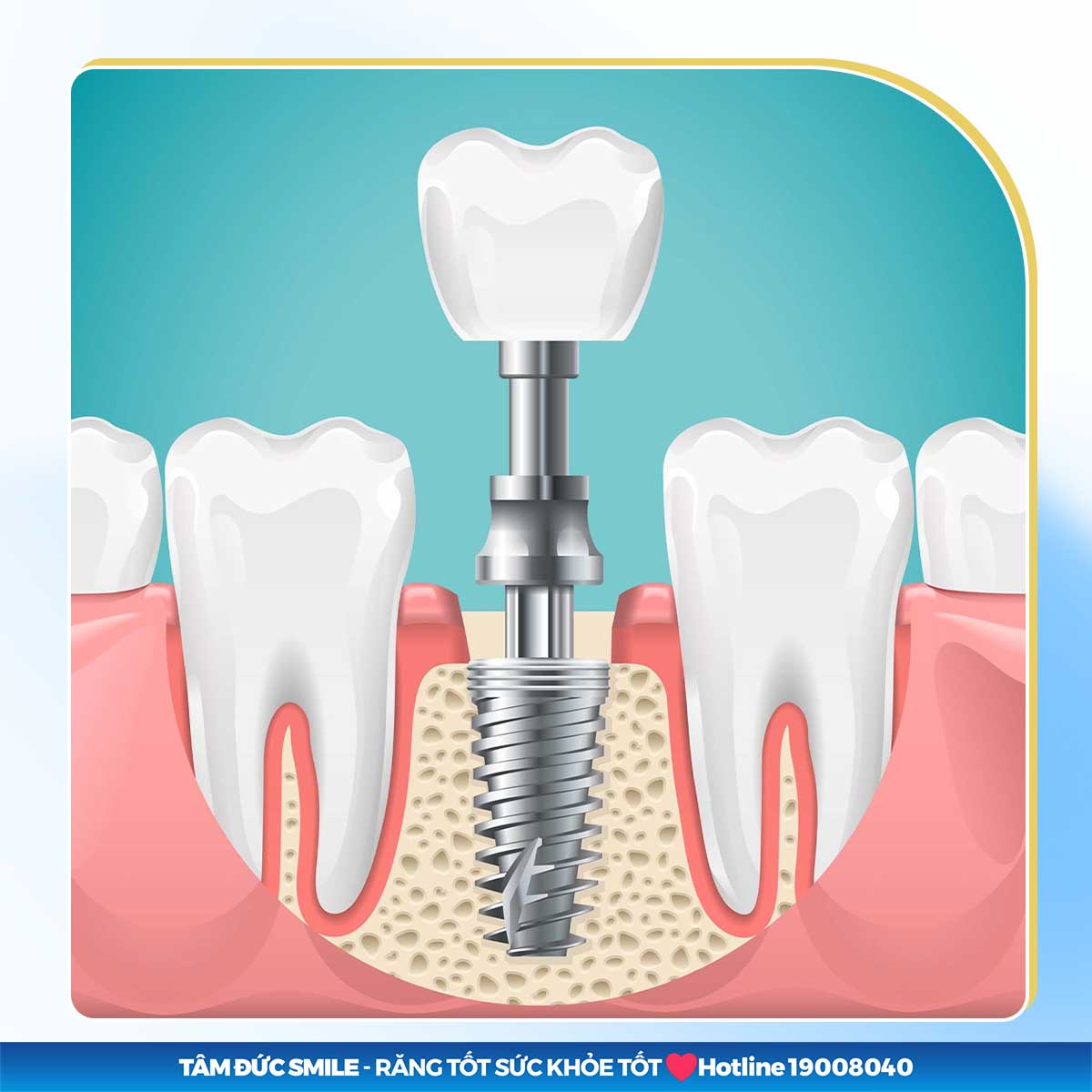 TRỒNG RĂNG IMPLANT LÀ GÌ? NHỮNG ĐIỀU CẦN BIẾT VỀ IMPLANT TRƯỚC KHI THỰC HIỆN